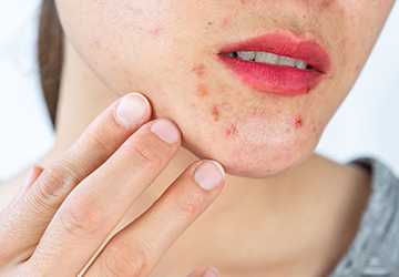 How to Prevent and Treat Acne Breakouts
