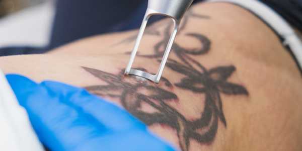 How Much Does It Cost To Remove A Tattoo?